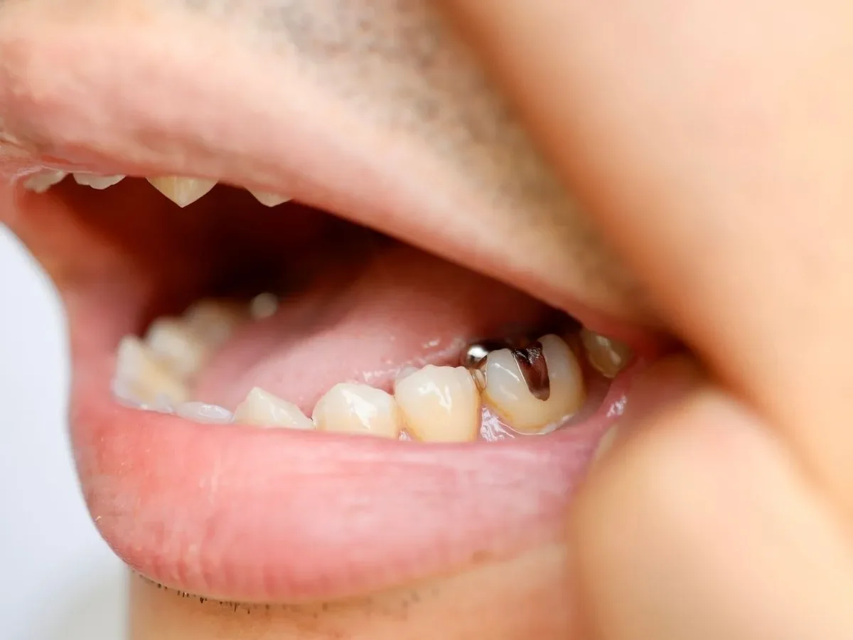 Finding an Emergency Dentist in Langley