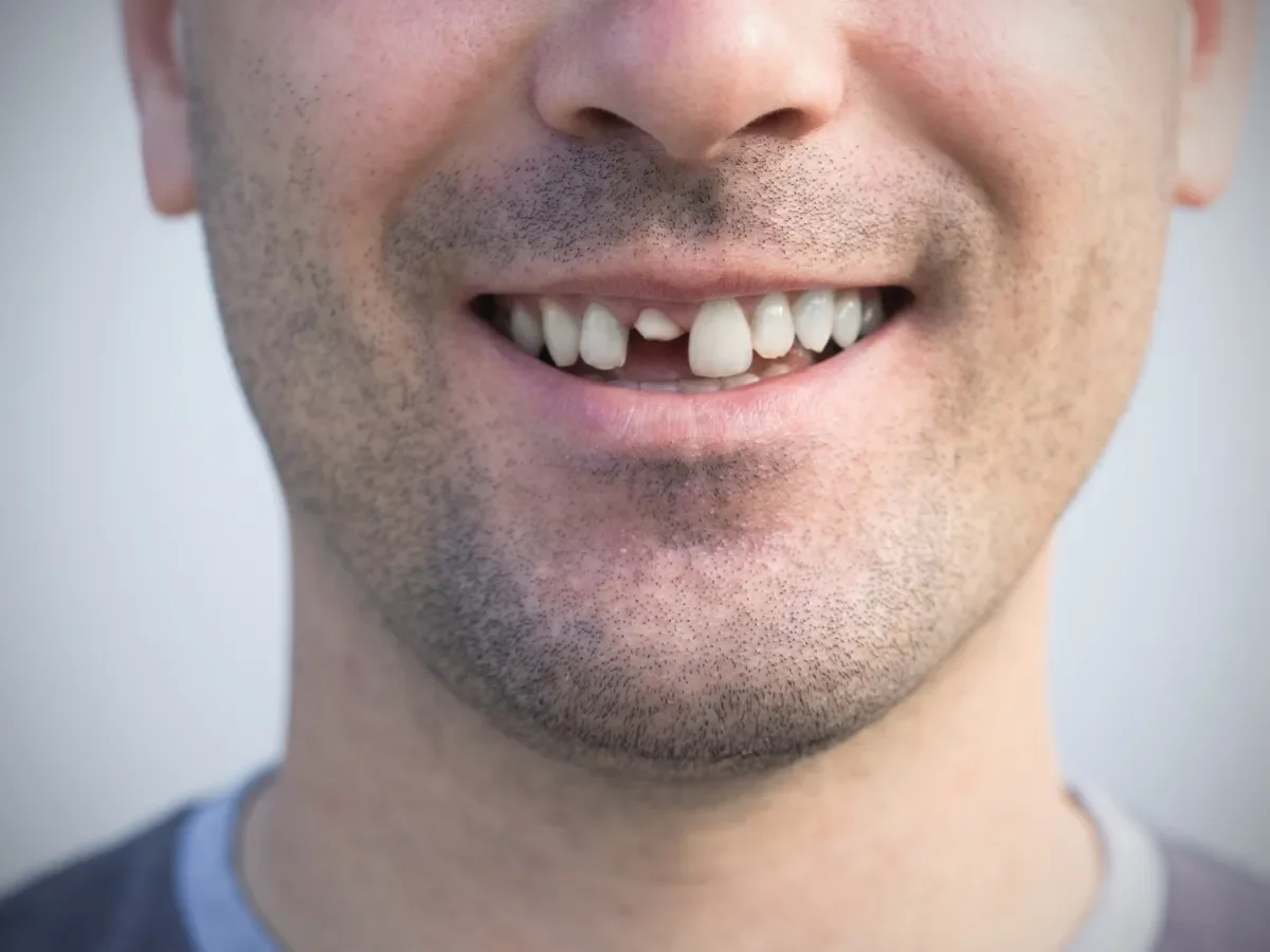 Managing a Cracked Tooth: Urgent Care Steps