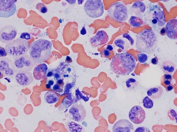 Blog 1 — Heme Onc Notes