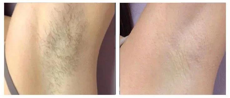 Risultati Epilazione Laser Napoli 1.jpeg