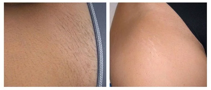 Risultati Epilazione Laser Napoli 2.jpeg