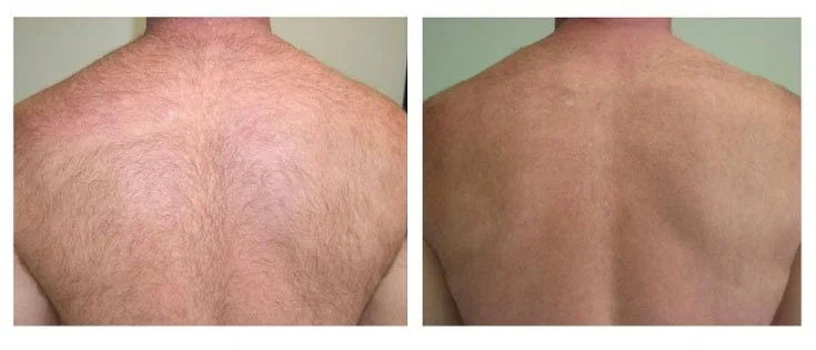 Risultati Epilazione Laser Napoli 3.jpeg