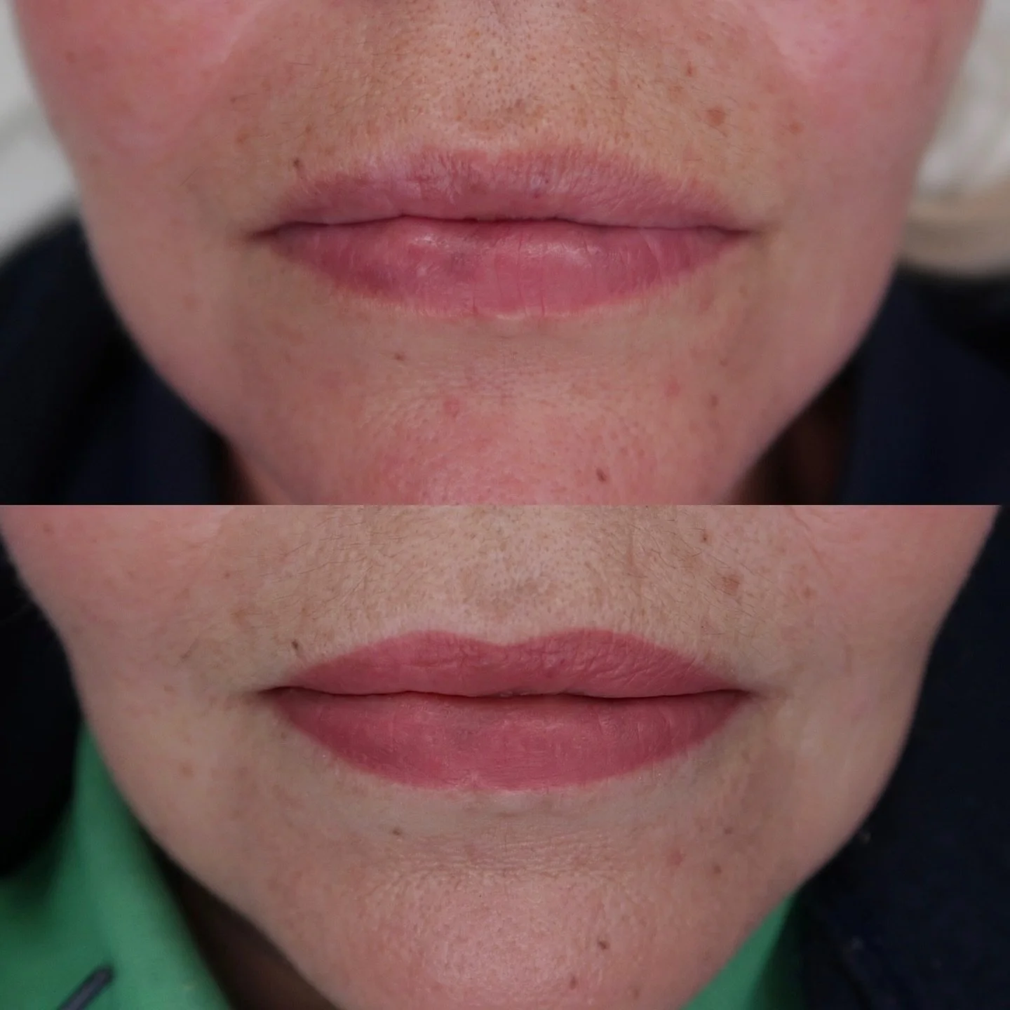 Seriously pleased with what was achieved with this lip blush! The client&rsquo;s goal was to even out the natural lip tone and enhance her existing shape. Where there are naturally darker areas of pigmentation in the lips these can still show through