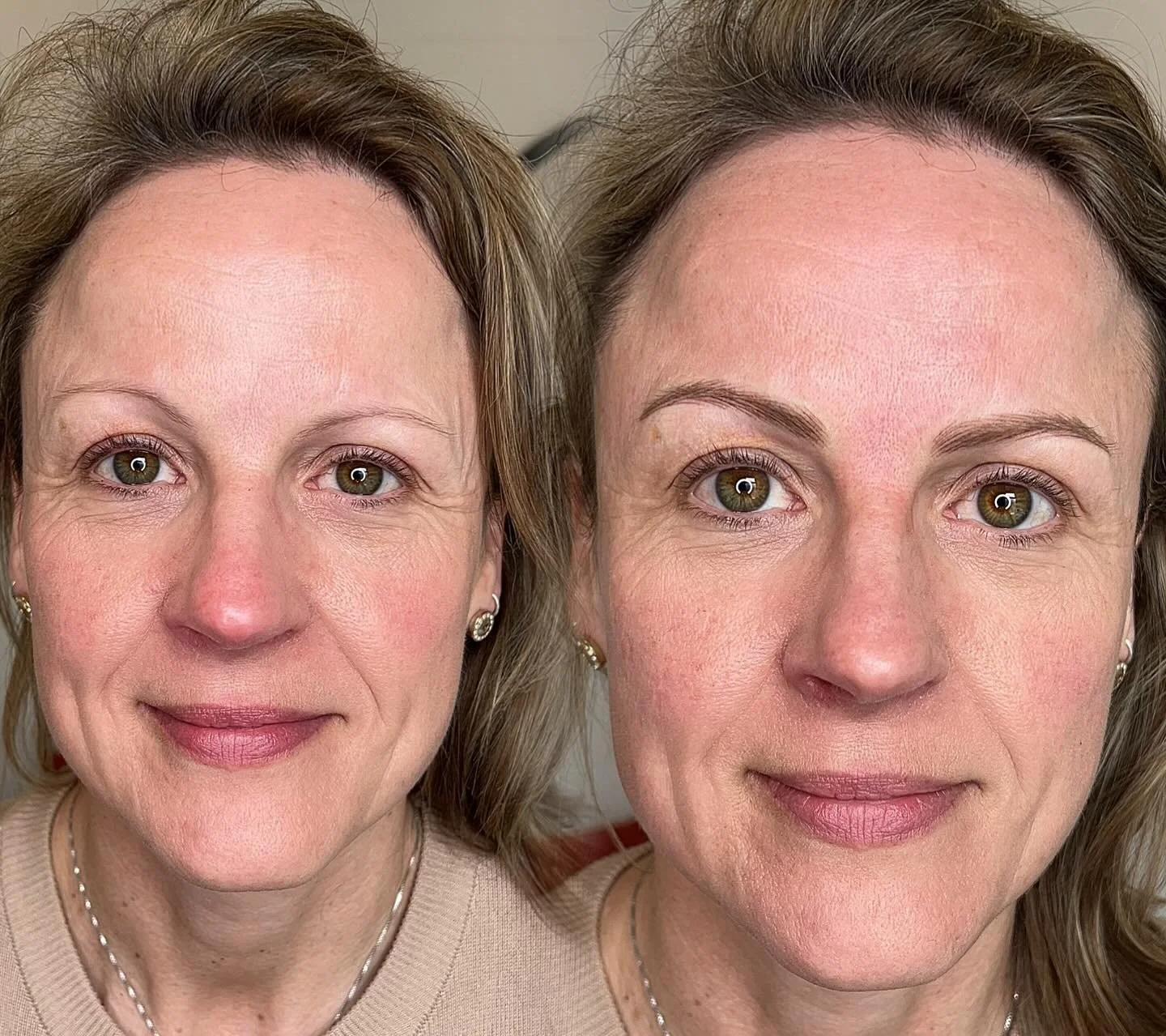 The Secret to an Instant Facelift