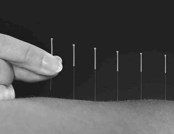 acupuncture safety