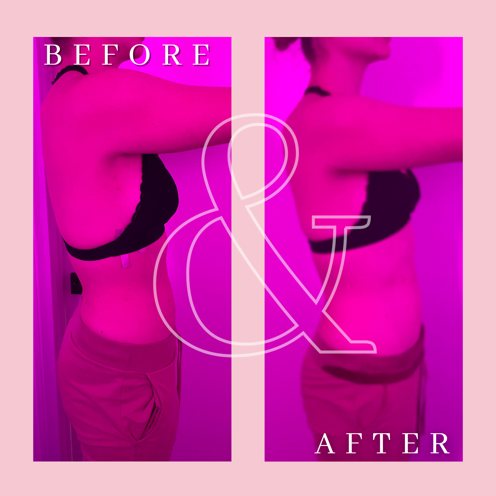 Side Cavitation Radio Frequency