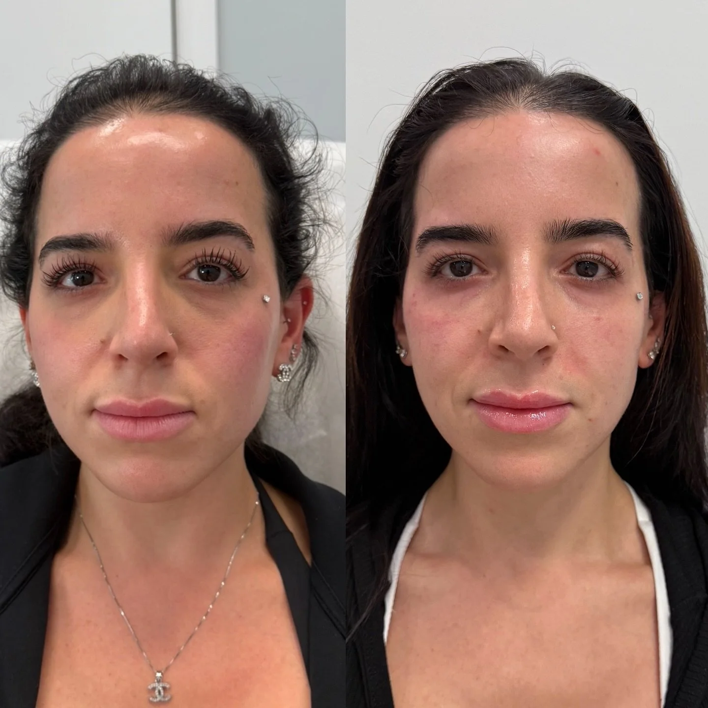 Face balancing for my beautiful girl — we used 5 syringes of volume and a lip flip. She looks naturally refreshed and radiant.✨
MM AESTHETICS 
📍68 Adams St Brooklyn, NY 11201
Dumbo location: 
Monday, Tuesday, Wednesday, Friday, Saturday, Sund