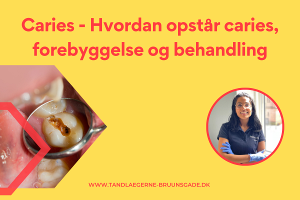 Caries - Hvordan opstår caries, forebyggelse og behandling