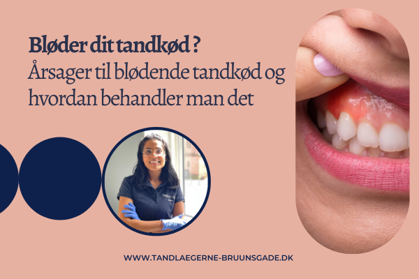 Bløder dit tandkød ? Årsager til blødende tandkød og hvordan behandler man det