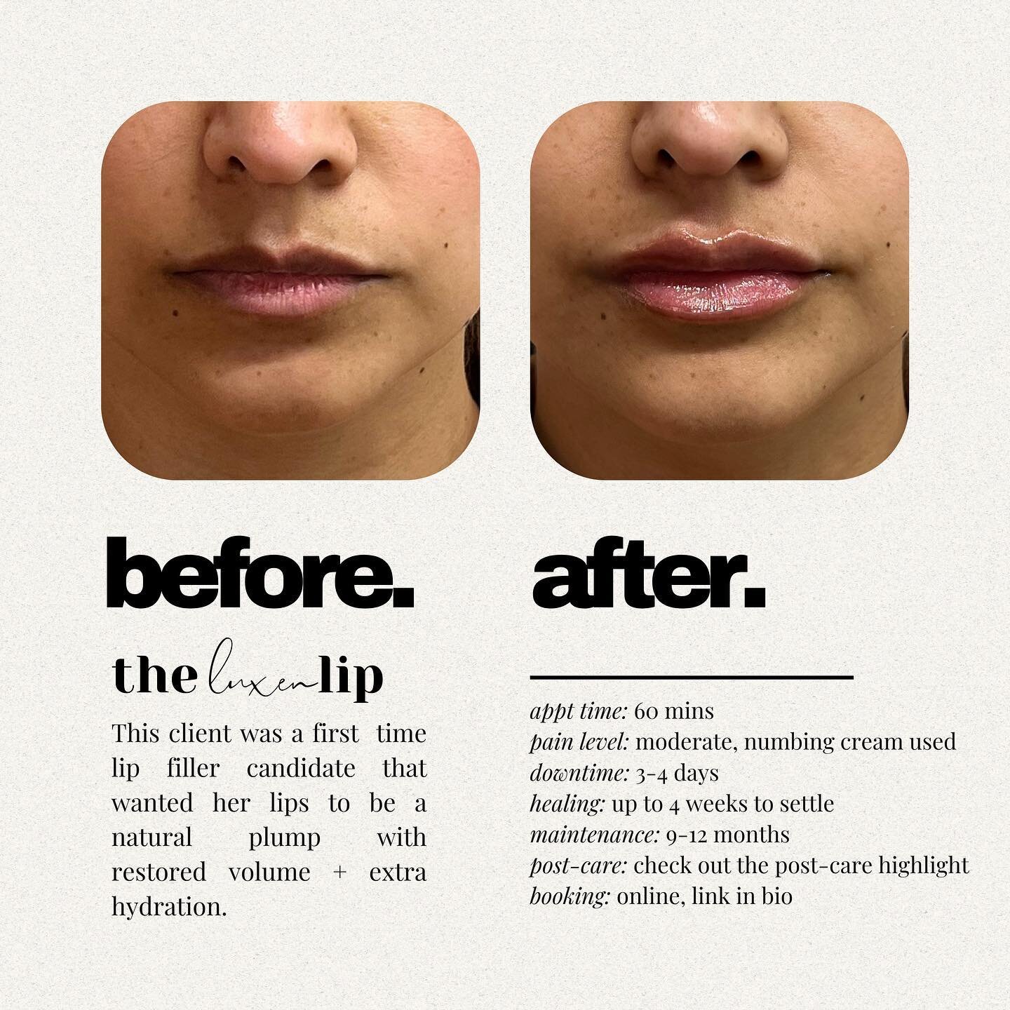 as a first time lip filler client, it&rsquo;s my job to help you achieve your natural lip goals with a subtle boost of volume + hydration ✨

#aestheticnurse #lipfiller #lipfillerbeforeandafter #lipinjections