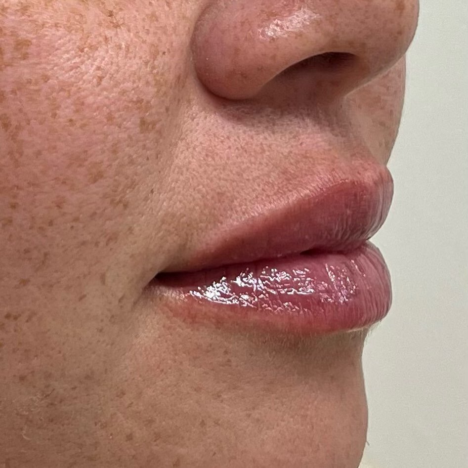 the perfect lip doesn&rsquo;t exi&mdash;

no but for real, restoring natural volume in your lips + adding some hydration is one of my fav things to do❣️

have you booked your appt for June yet? books are filling up fast 📲 

#nurseinjector #lipfiller