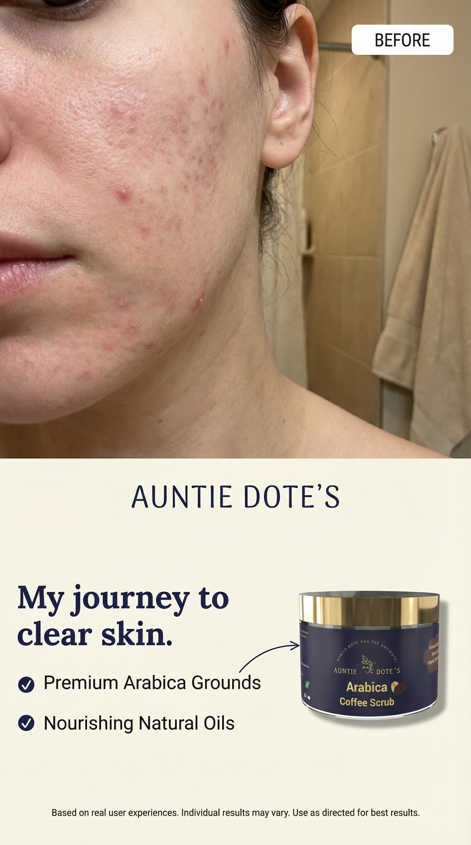 Close-up of a person's face showing acne before treatment, with a towel and cabinet in the background, and part of a skincare product package at the bottom.