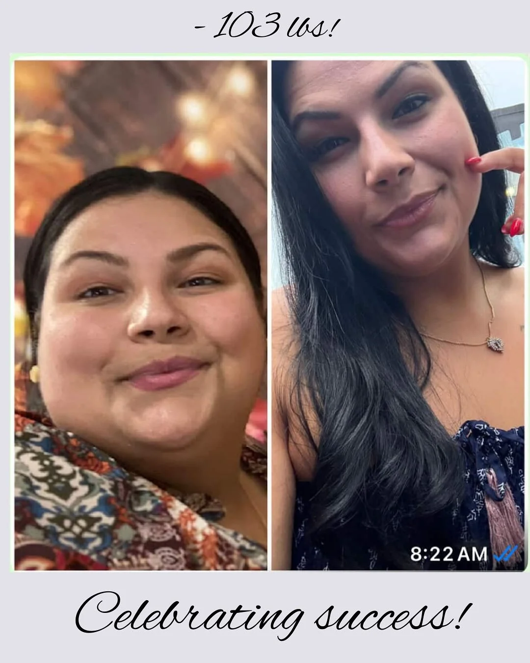 So proud of our amazing patients! 
Gone: -103 lbs ❎
Hello: Better health, resolution of co-morbidities! ✅

#BariatricSurgery #WeightLossSurgery #BariatricJourney #BariatricLife #BariatricSuccess #SleeveGastrectomy #GastricSleeveJourney #RNYBypass #Ba