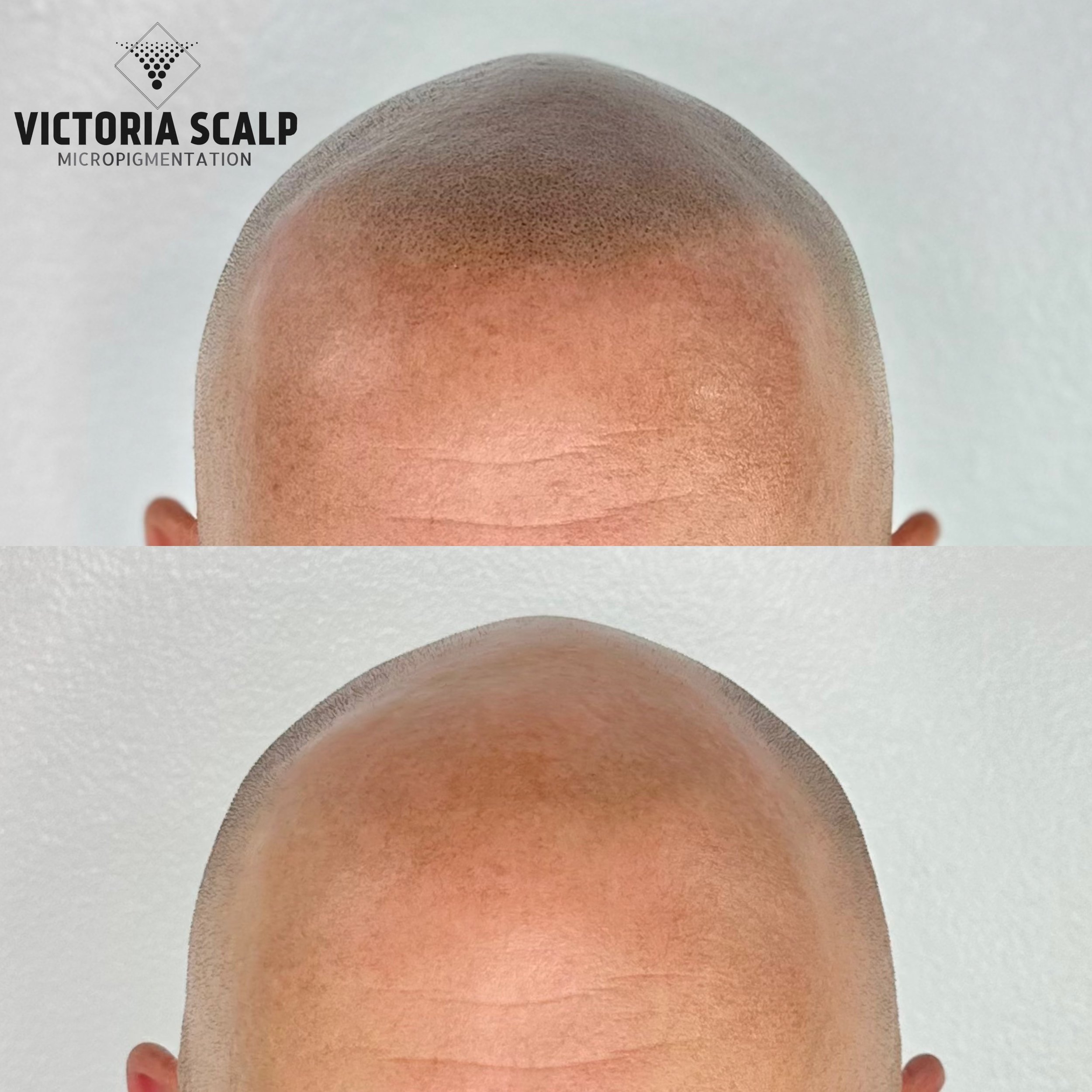 SHAVED HEAD SMP - VICTORIA SCALP