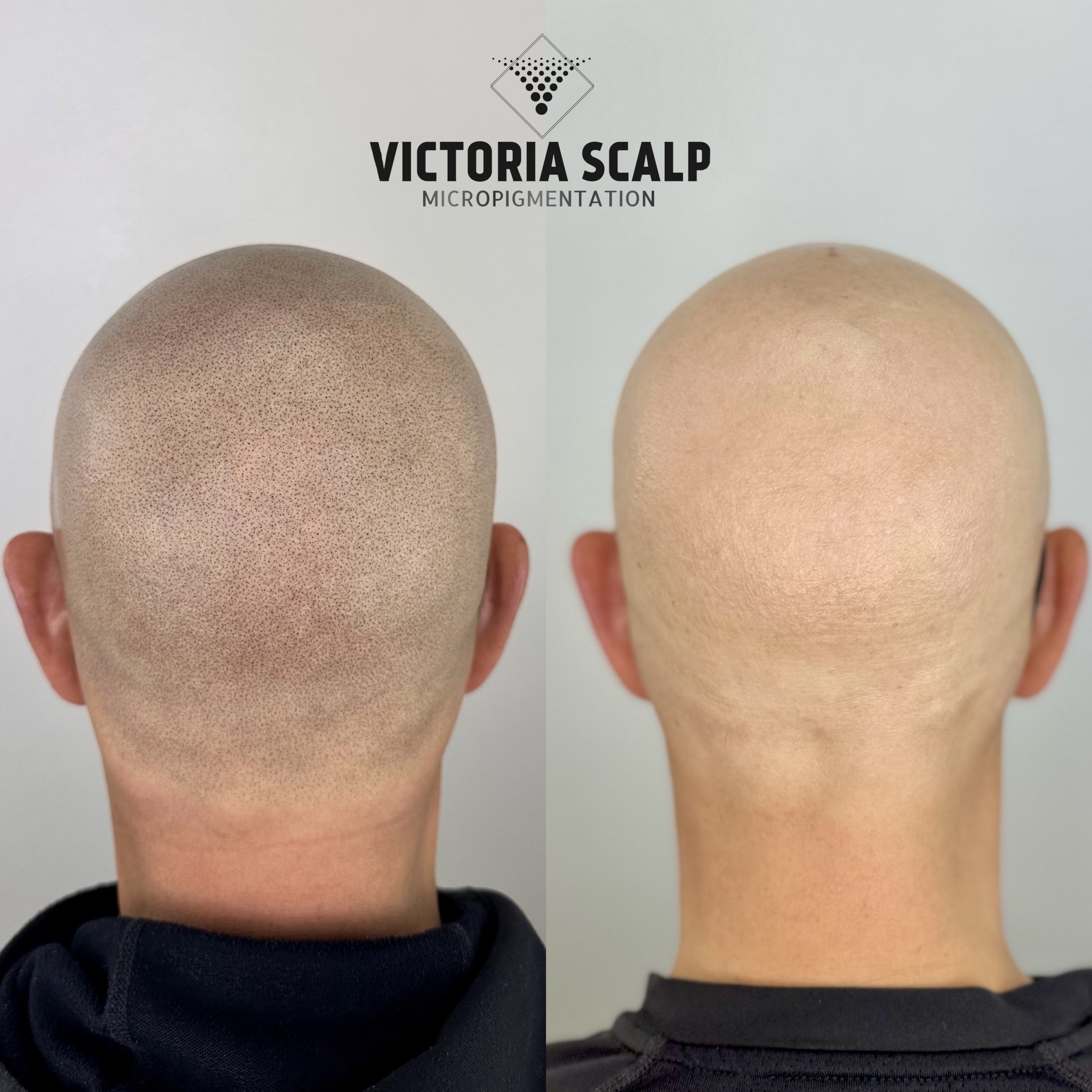 SHAVED HEAD SMP 
