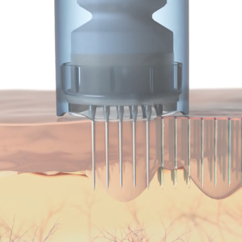 how_does_microneedling_work 1.png
