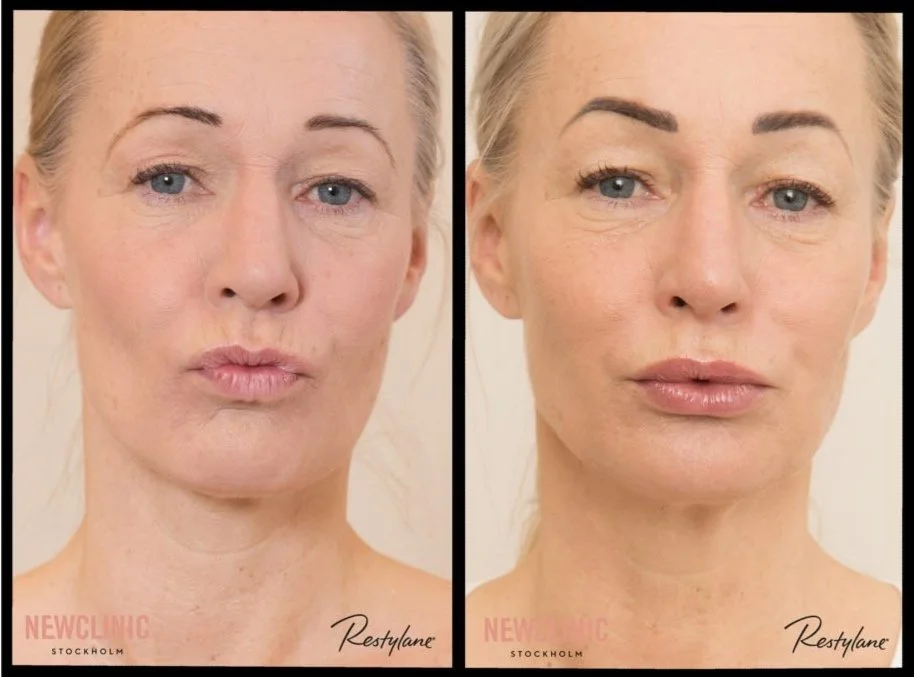 BOTOX New Clinic BOTOX New Clinic