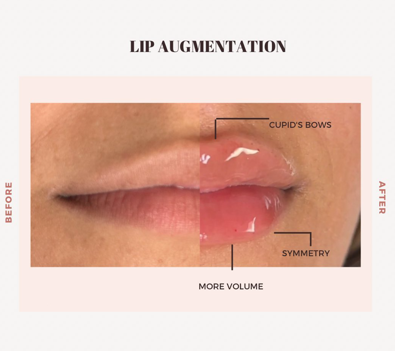 Enhance your natural beauty with our mini lip filler treatment! Achieve subtle and refined results that enhance your lip shape, volume and symmetry.