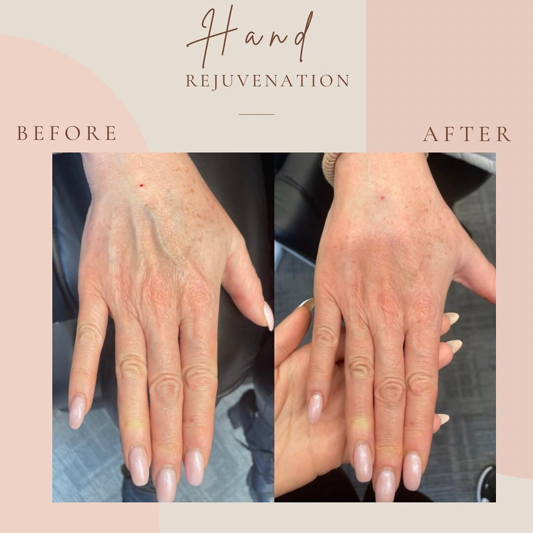 🌟 Hand Rejuvenation Transformation with Radiesse! 🌟

✨ Before Treatment: On the left client&rsquo;s hands show signs of aging, volume loss, and wrinkles.

✨ Introducing The Secret Weapon - Radiesse. This remarkable dermal filler contains calcium hy