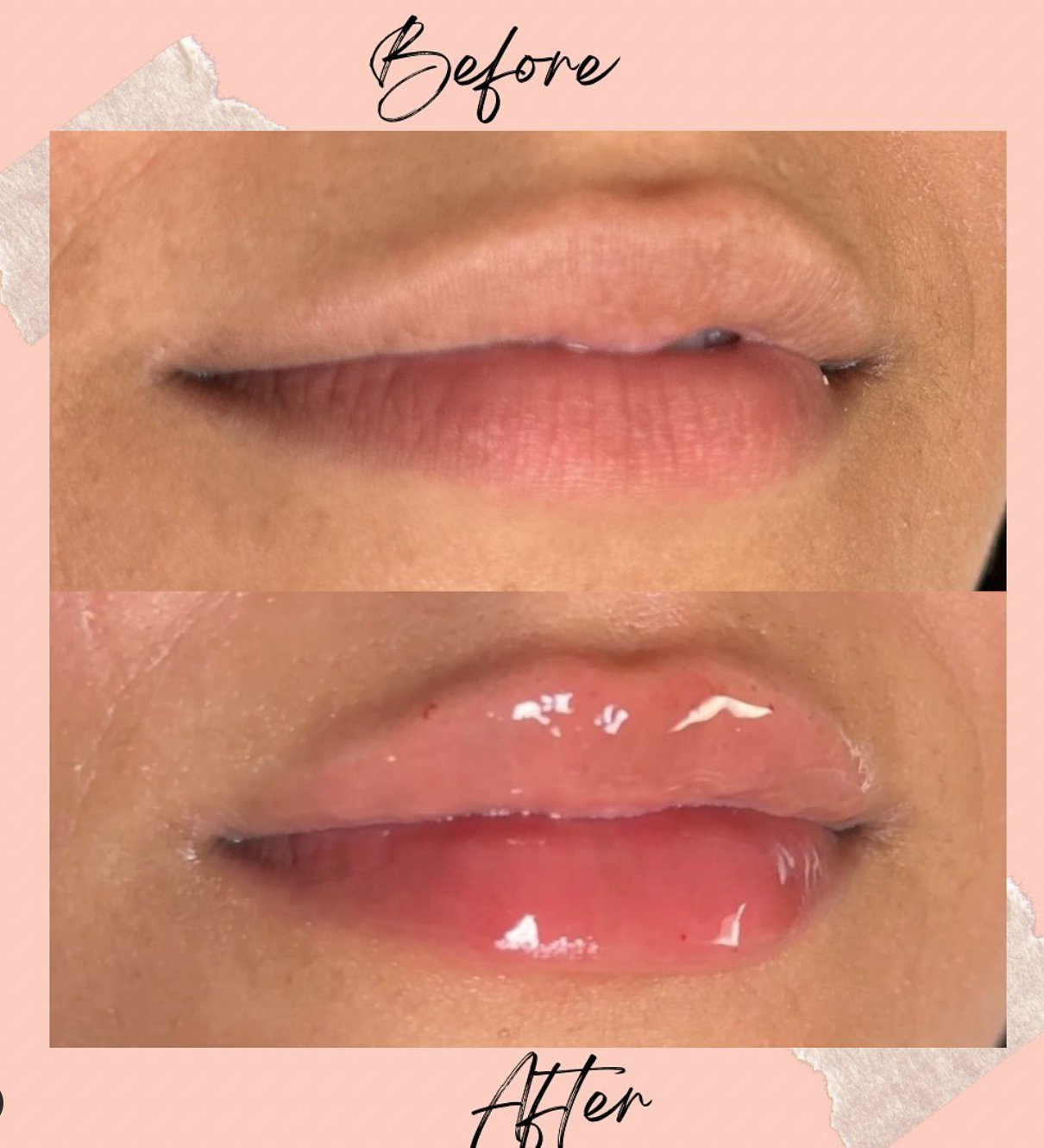 Did you know that we offer Mini lip filler that can create a noticeable transformation, like the stunning results you see here? 😍✨

Whether you're looking to add volume, define the lip borders, or achieve a more balanced smile, lip fillers can help 