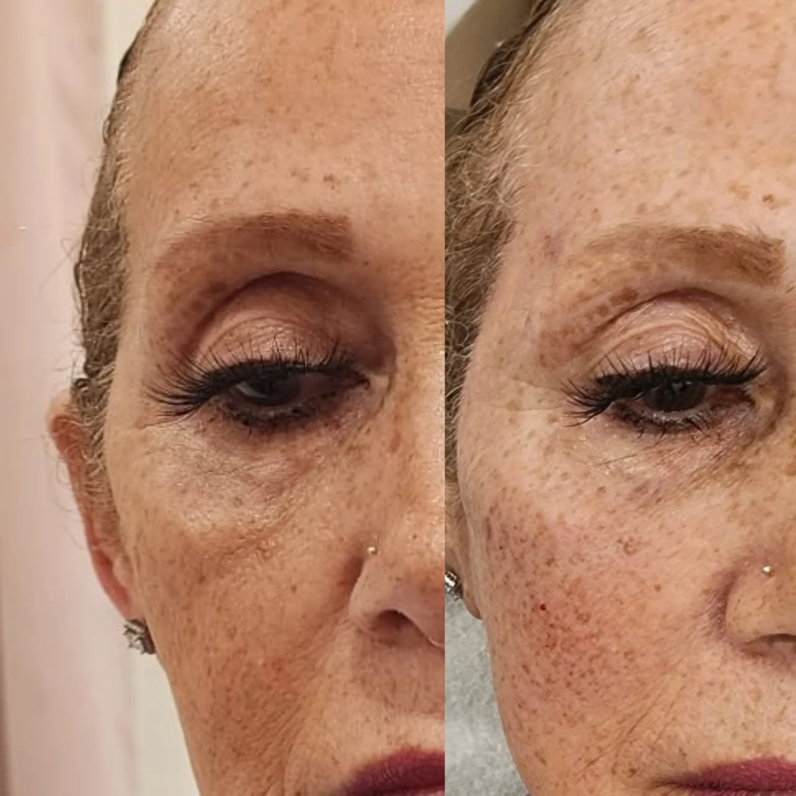 Experience the Magic of Temple Filler! Restore lost volume, smooth fine lines, and rejuvenate your appearance effortlessly. Our temple filler treatments enhance your natural beauty, creating a refreshed and youthful look. Uncover the secret to a more