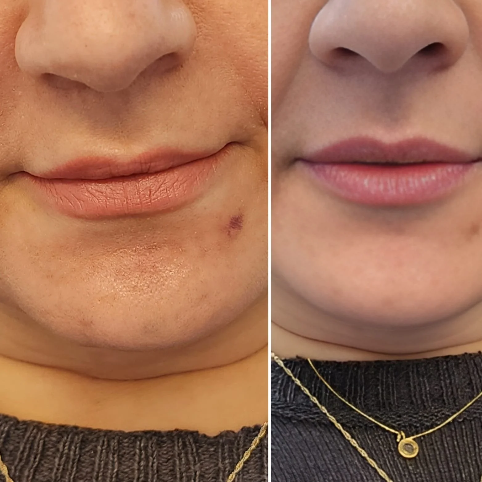 Fix asymmetry and adding volume with lip filler
