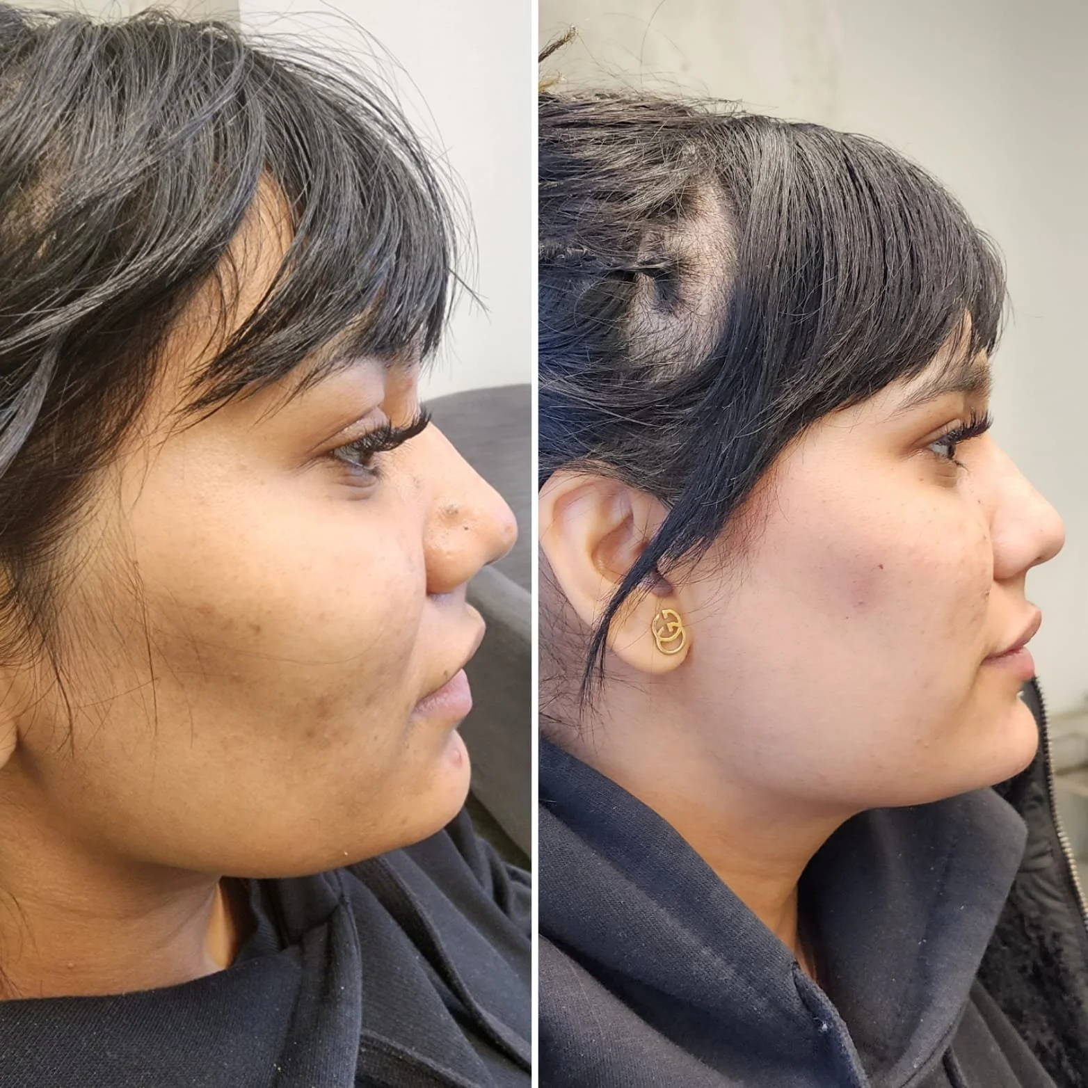 Chisel Your Confidence: Discover the Power of Jawline Filler! Define your features, enhance your profile, and radiate confidence with our expert jawline filler treatments. Unveil a sculpted, youthful jawline that complements your natural beauty.