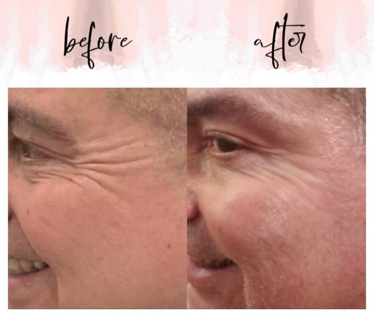 What is the difference between Botox and baby Botox?

Baby Botox works the same as traditional botox but with smaller doses. The area treated will appear more natural-looking when compared to traditional botox.