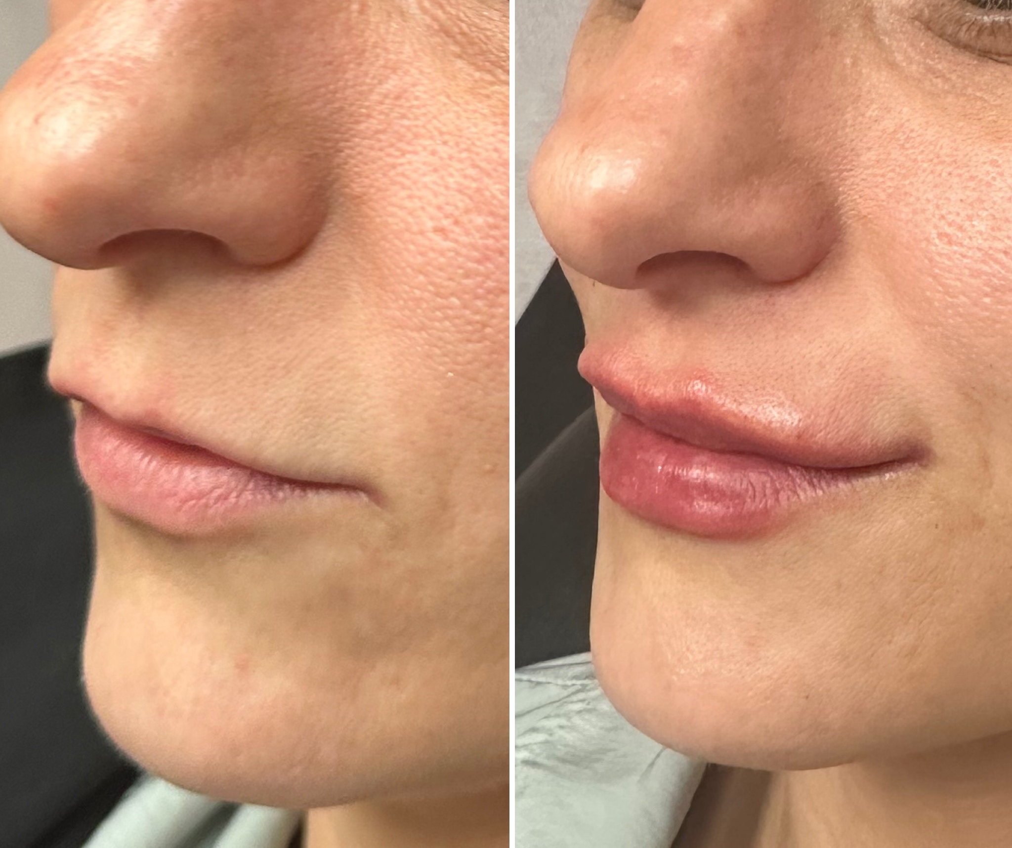 Before and after lip filler results showing natural-looking volume and improved lip symmetry