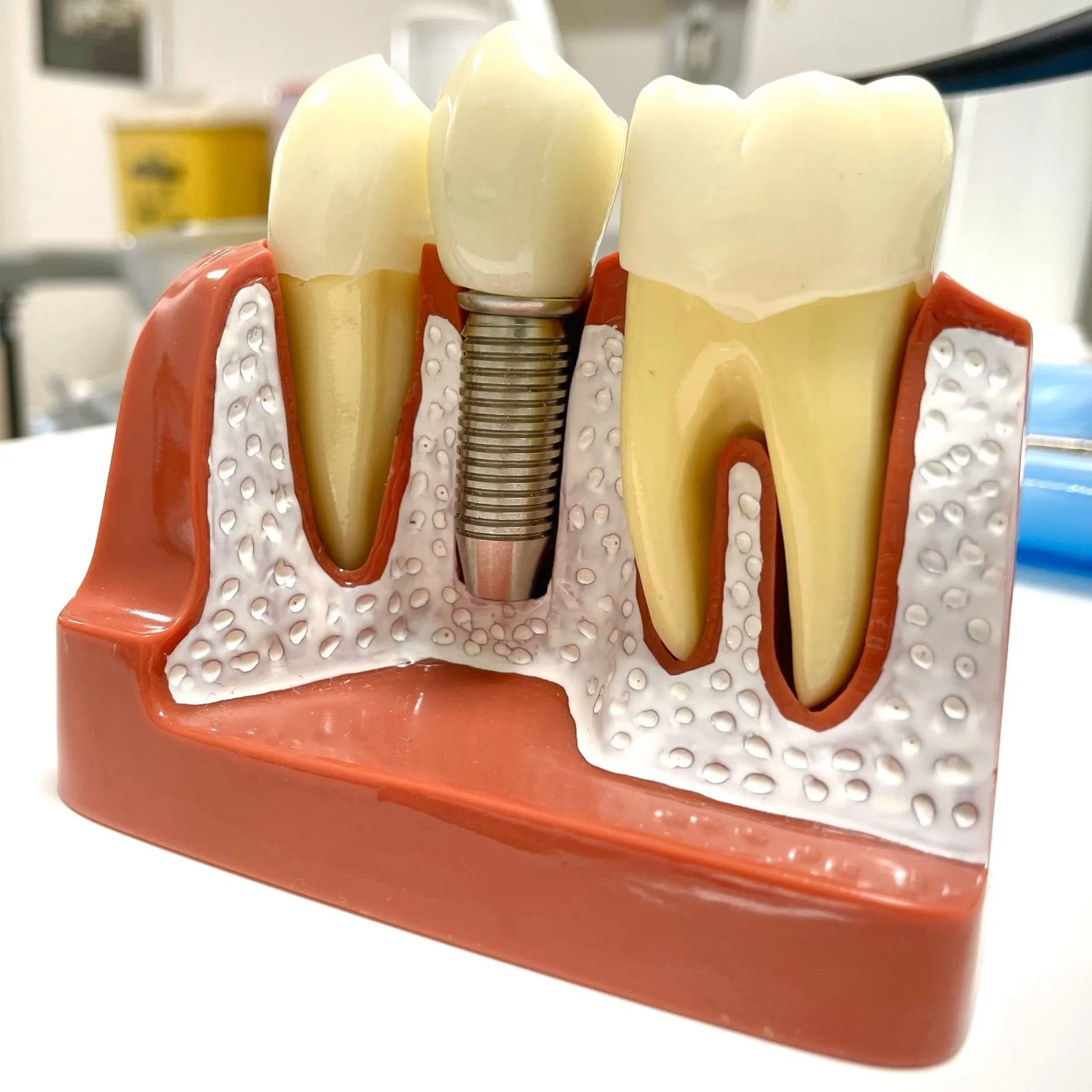 Model of a dental implant in the gum, showing two teeth, a metal screw in the jawbone, and surrounding gum tissue.
