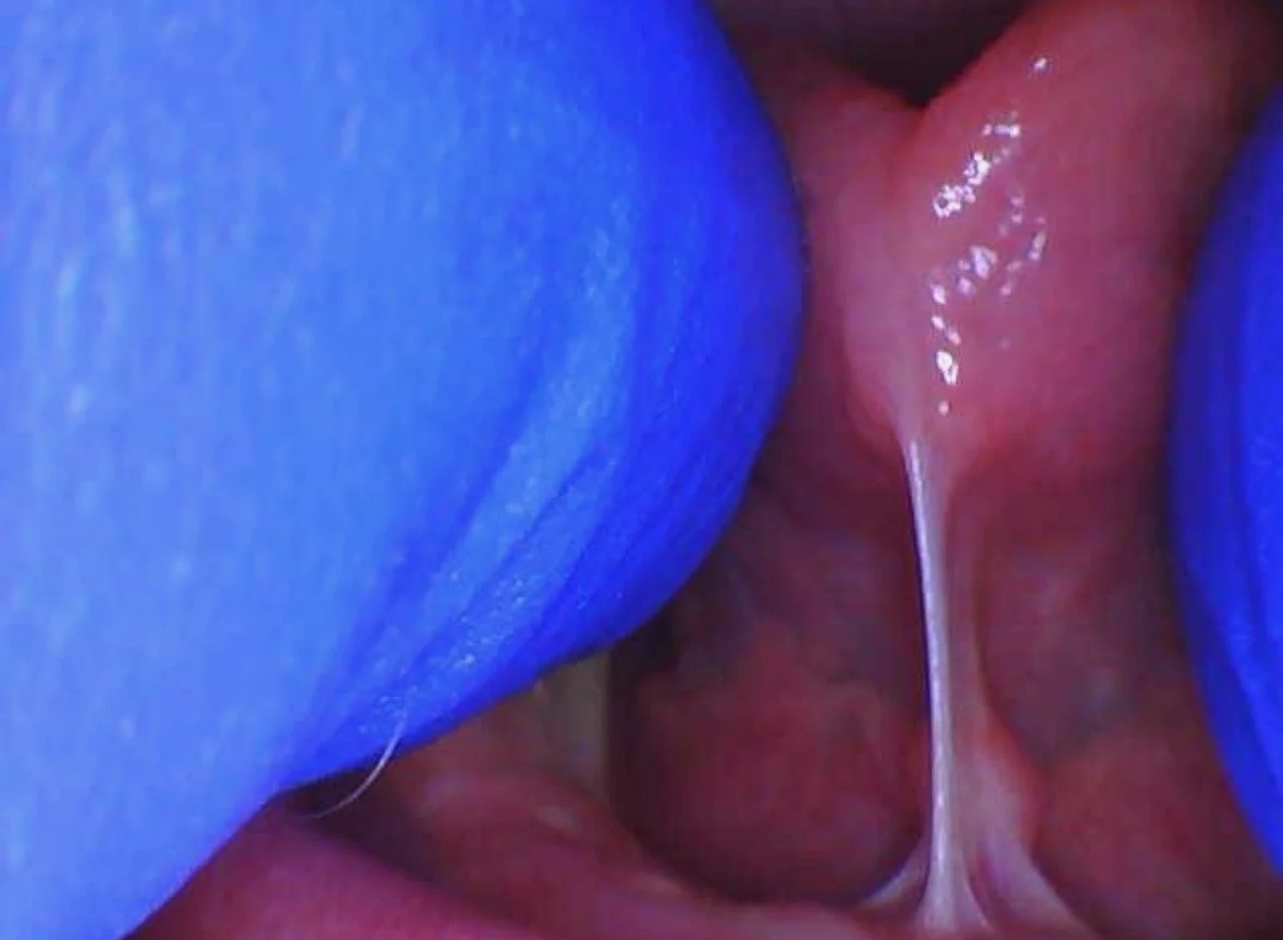 Oral Ties and Body Tension: Understanding the Connection and Why It Matters for Feeding