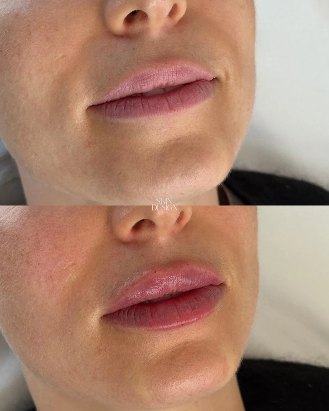 Preenchimento Labial com Ácido Hialurónico