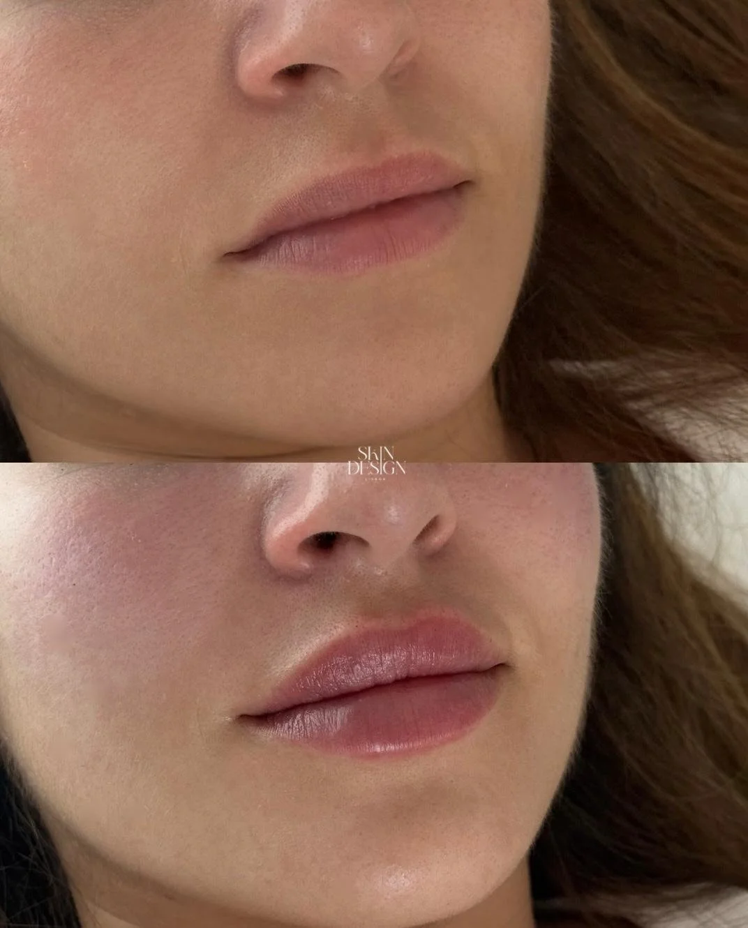 Preenchimento Labial com Ácido Hialurónico