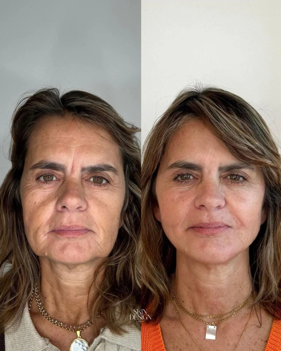 Harmonização Facial Completa e Bioestimuladores Sculptra 