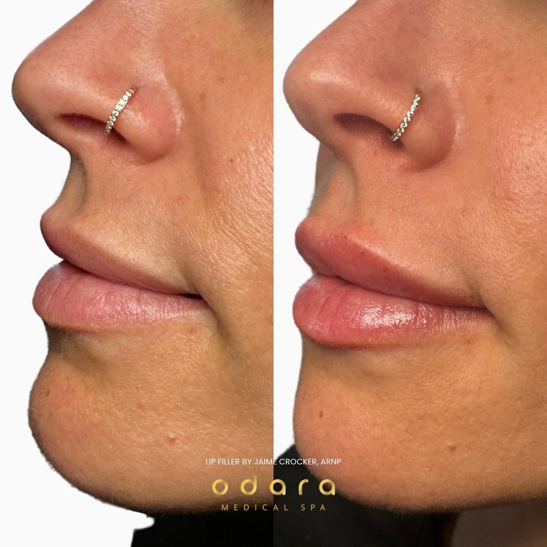 The perfect lip plump just in time for summer! Natural and stunning results by Jaime Crocker, ARNP 💋 

Spokane summer is right around the corner and we can&rsquo;t wait to get all of our beautiful clients ready! Make sure to call and schedule your a