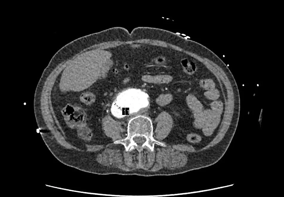 Aortocaval fistula (1).jpg