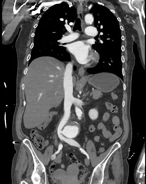 Aortocaval fistula 2 (1).jpg