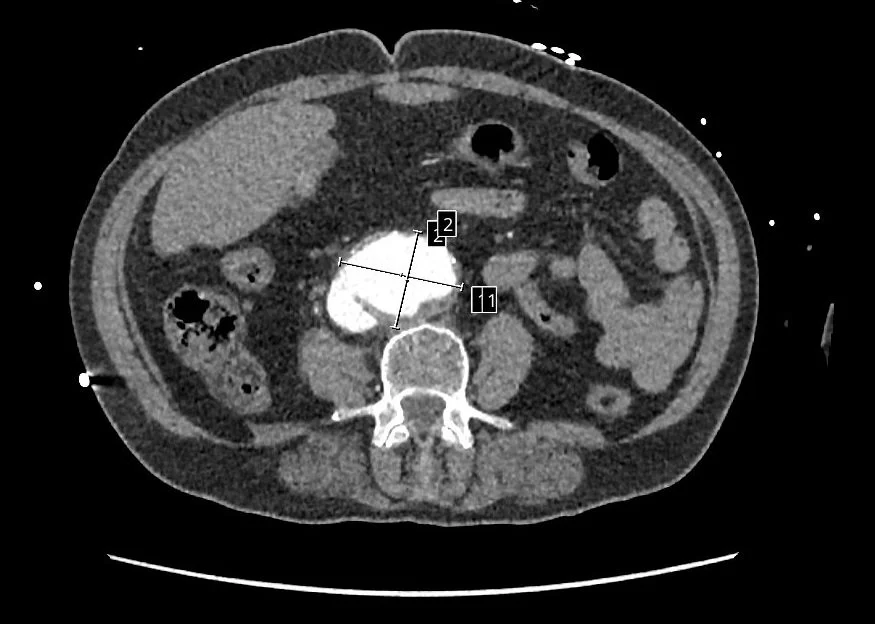 Aortocaval fistula 3.jpg