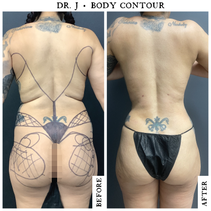 Lipo360-Female5.1.png