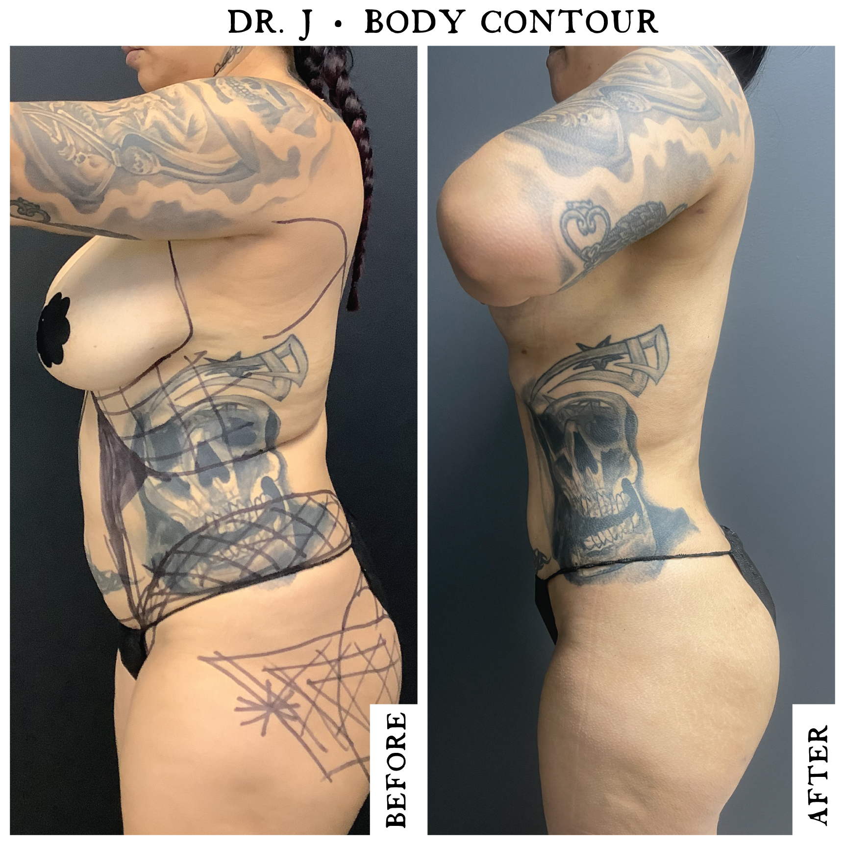 Lipo360-Female5.2.png