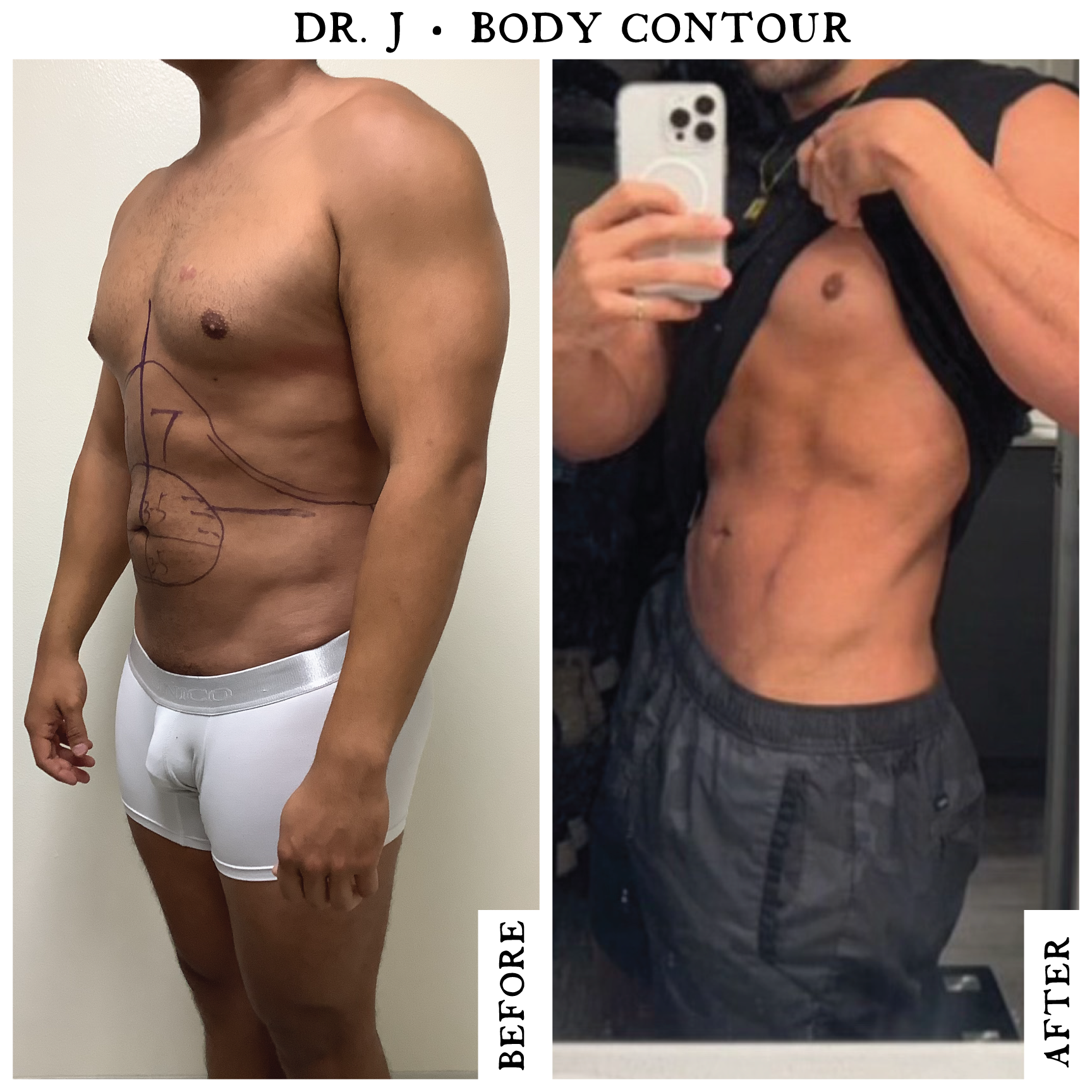 Abdomen-Male1.png