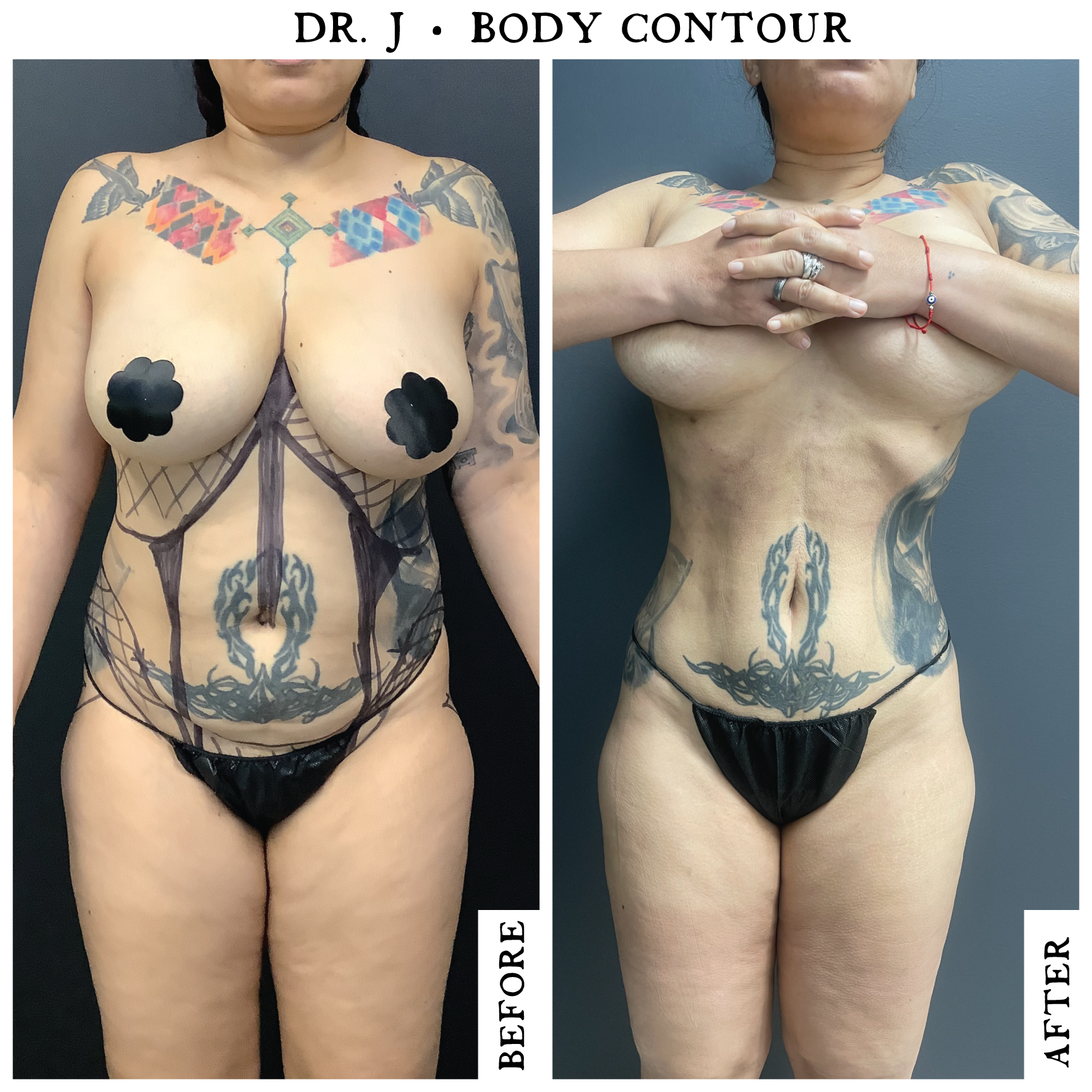 Lipo360-Female5.3.png