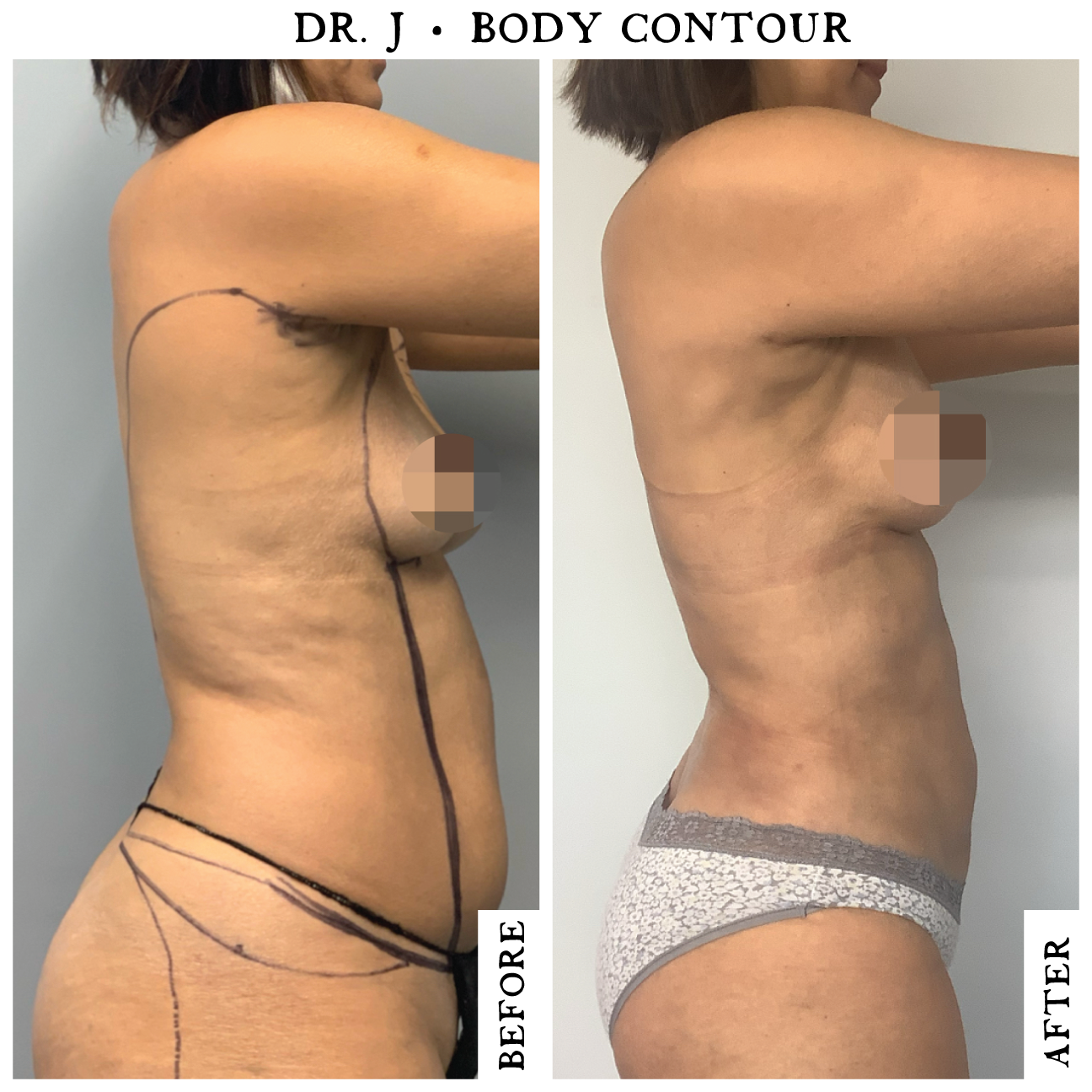 Lipo360-Female3.2.png