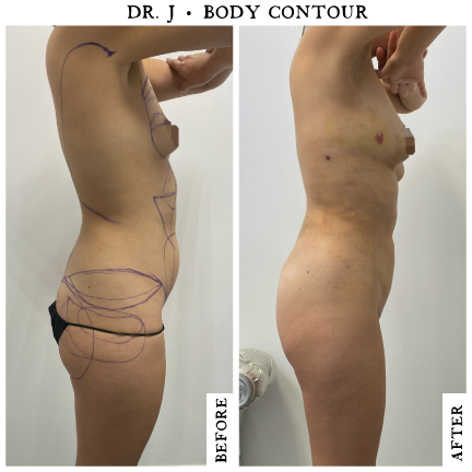 Lipo360-FemaleSide.png