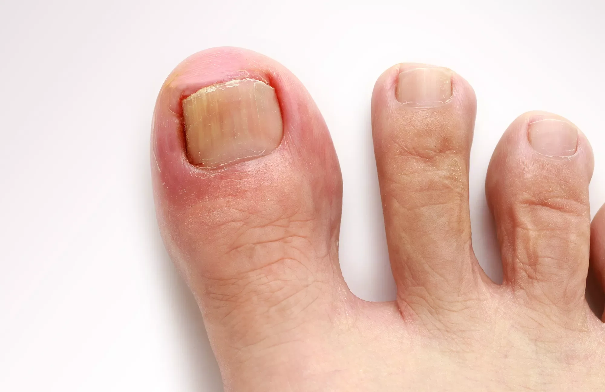 Doigts de pied avec ongles épais, décolorés et déchiquetés.