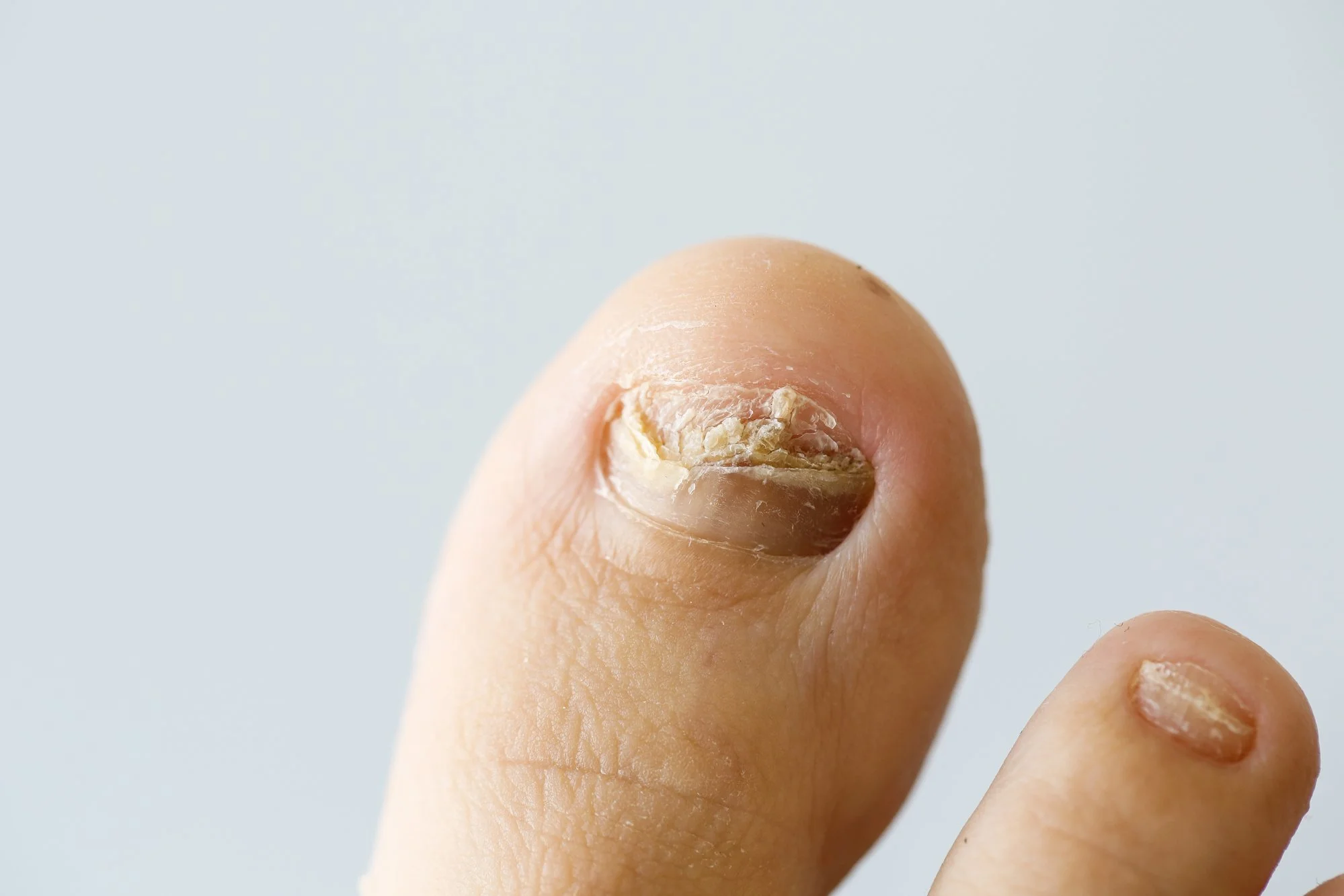 Un doigt, en gros plan, avec la peau qui semble sèche et craquelée, et la phalange du bout du doigt visible.