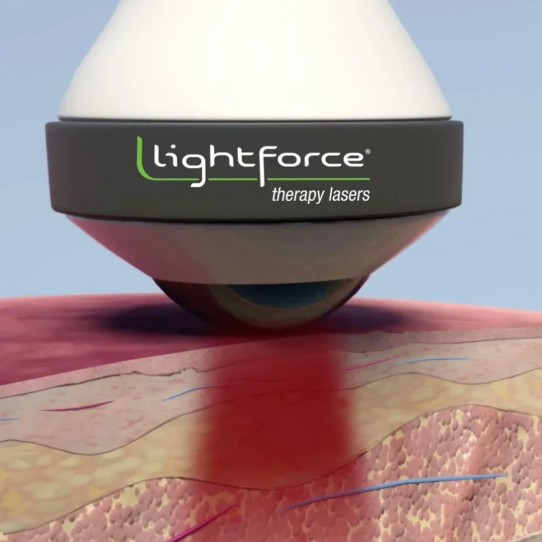 Dispositif médical appelé Lightforce utilisant des lasers de thérapie, appliqué sur la peau humaine, illustrant la pénétration des laser dans les tissus.