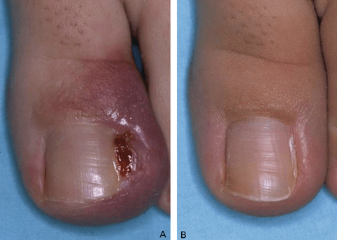 Comparaison d'un ongle d'orteil avec une infection ou blessure, montrant une amélioration après traitement.