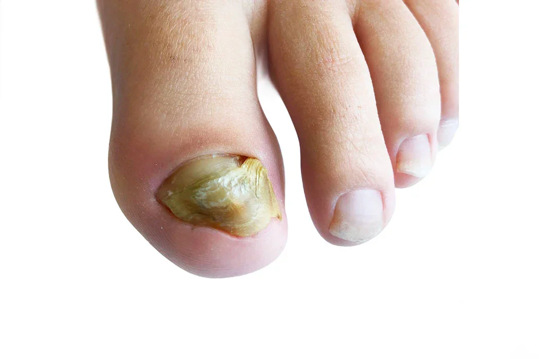 Ongle de gros plan sur un gros ongle incarné jaune avec une infection.