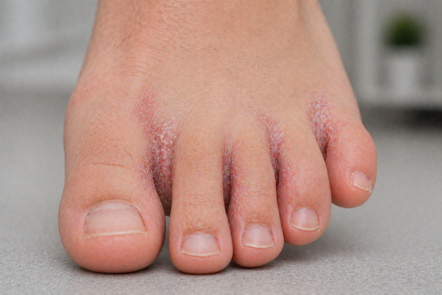Doigts de pied avec des cors et des peaux fendillées.